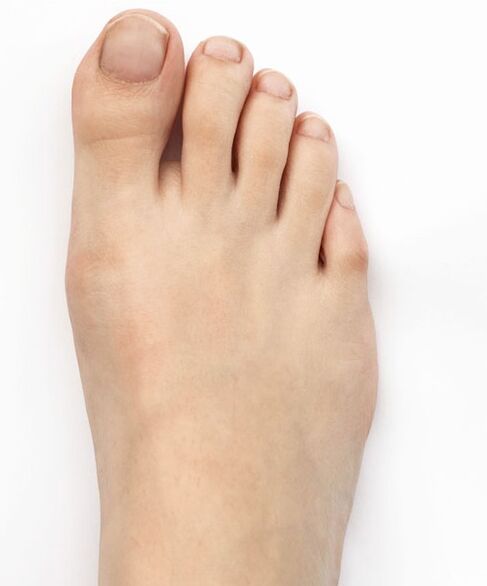 J'ai guéri mon valgus du pouce avec le spray Hondro Sol Valgus