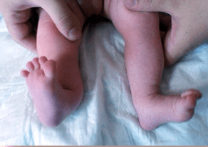 Déformation valgus chez les enfants symptômes