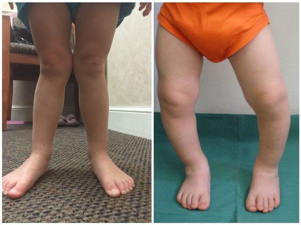 La déformation valgus chez les enfants provoque