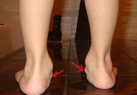 Déformation valgus des pieds chez les enfants