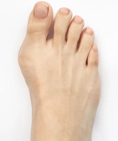 hallux valgus avant d'utiliser le spray Hondro Sol Valgus